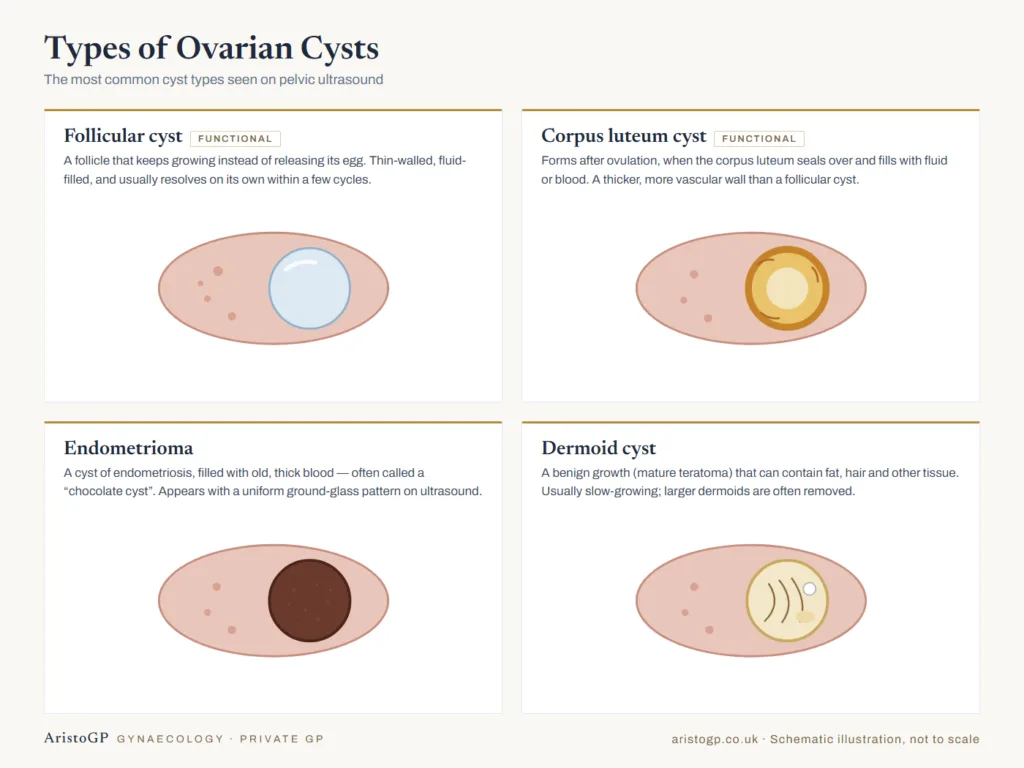 Diagram of ovarian cyst types: follicular cyst, corpus luteum cyst, endometrioma and dermoid cyst shown in the ovary