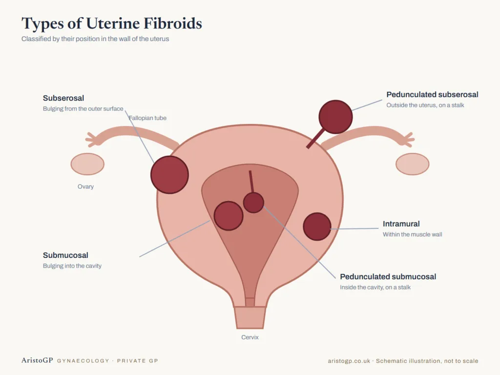 Diagram of uterine fibroid types: submucosal, intramural, subserosal and pedunculated fibroids in the uterus